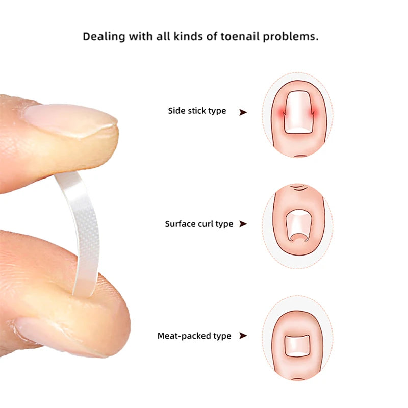 10pcs Ingrown Toe Nail Treatment Ingrown Toenail Correction Tool Elastic Patch Sticker Straightening Clip Brace Pedicure Tool